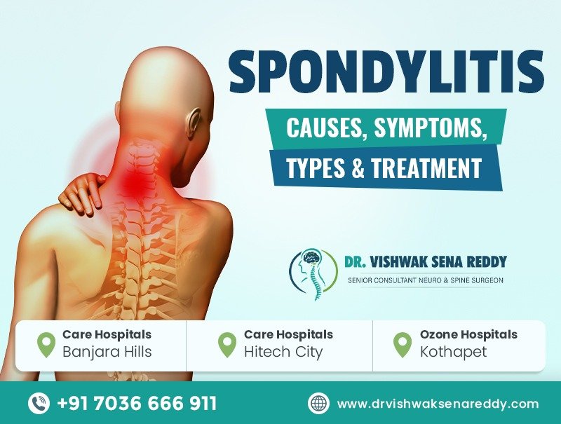 Spondylitis Treatment in Hyderabad