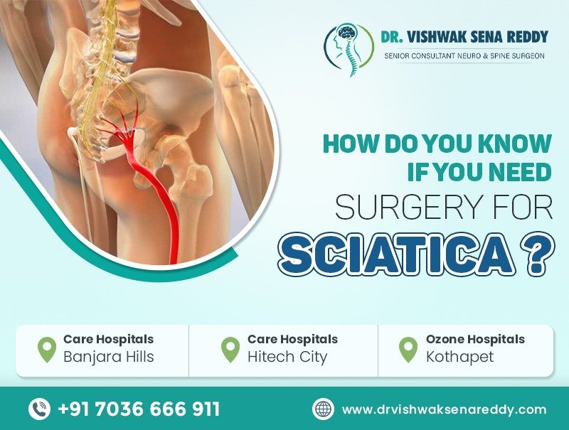 How Do You Know If You Need Surgery for Sciatica?