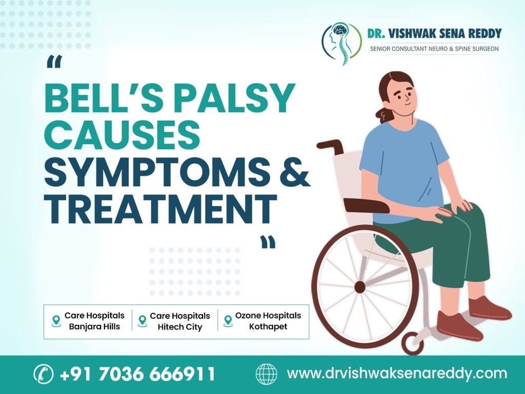 Bell’s Palsy – Causes, Symptoms and Treatment